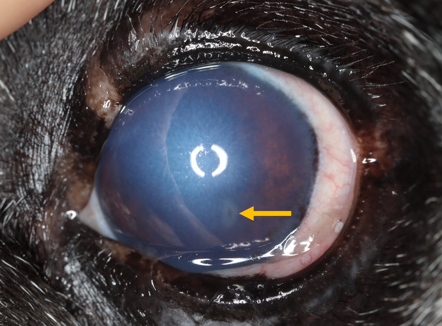 An eye with corneal oedema due top endothelial degeneration and a small corneal ulcer