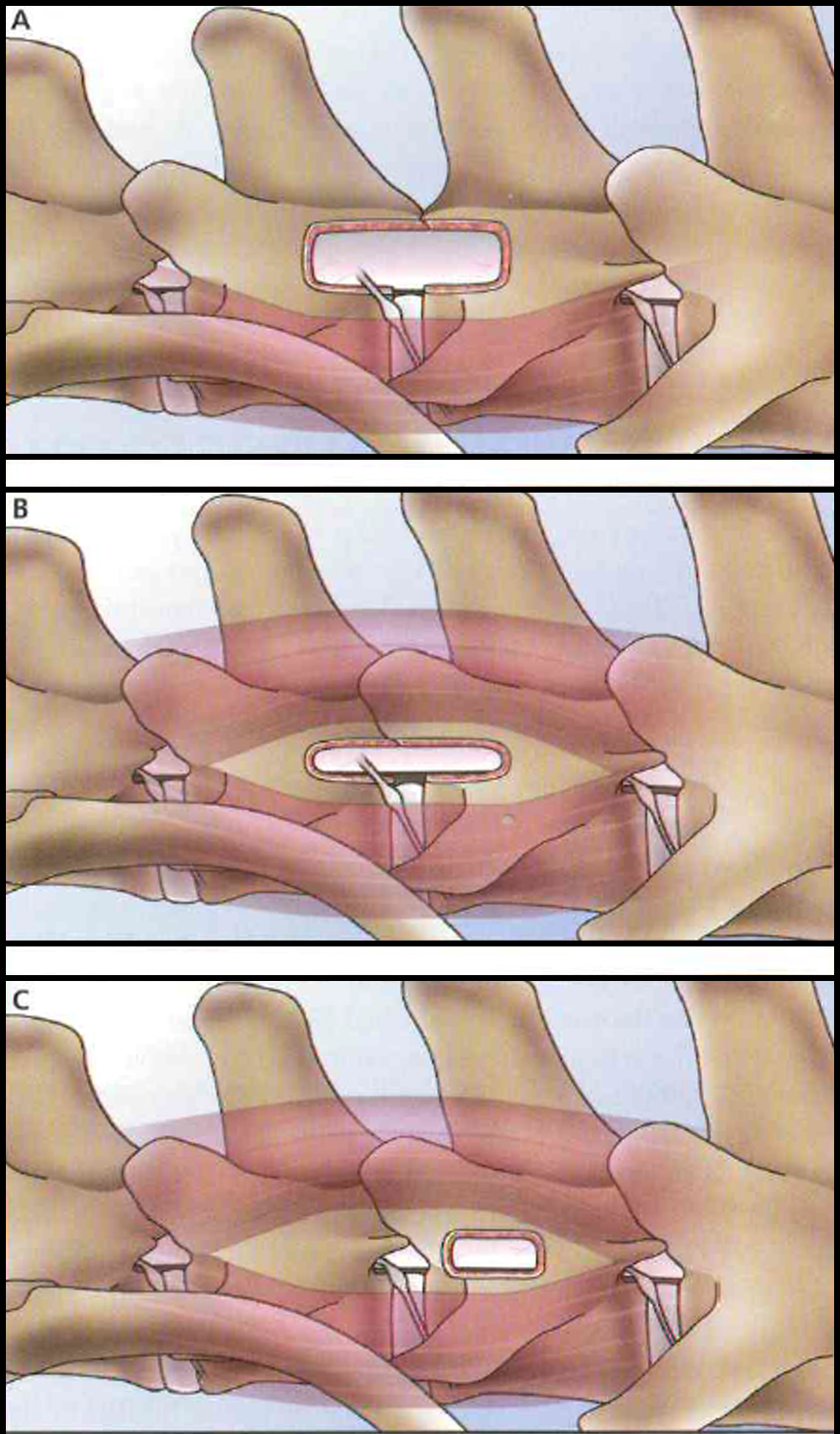 Corpectomy