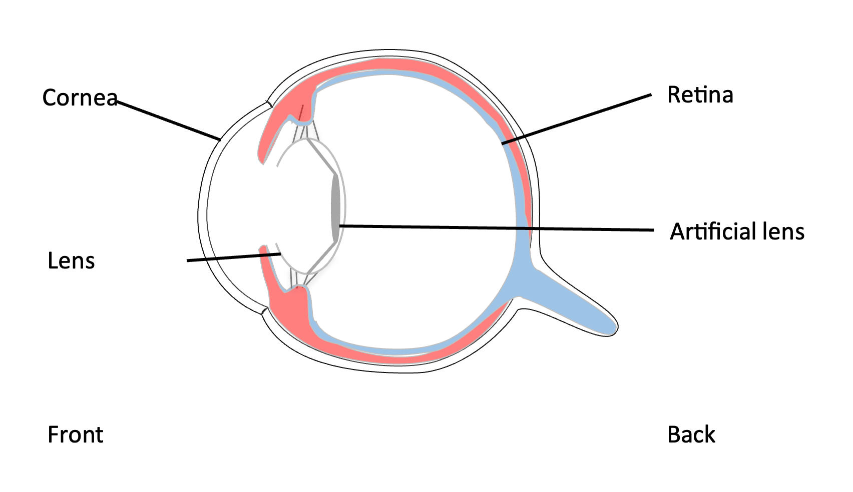 Diagram to show an artificial lens placed in the lens capsule after cataract removal