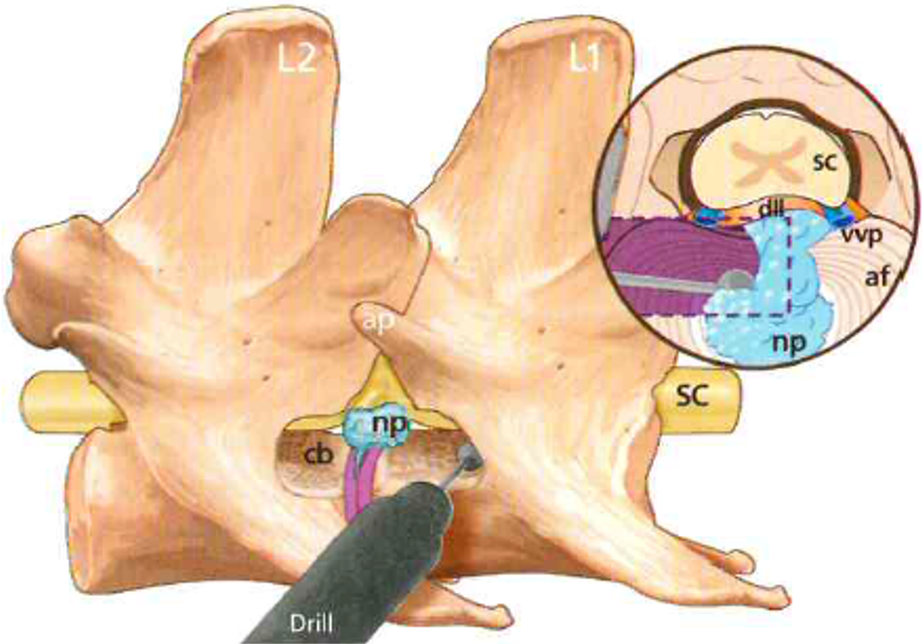 Dorsal laminectomy