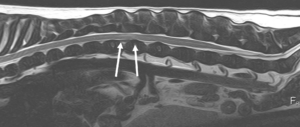 MRI image of T2 weighted sagittal lumbar spine showing the spinal cord contusion of an acute non-compressive IVVD at L1-L2. There is an attenuation of the spinal cord epidural (fat) and subarachnoid (fluid) signal (arrows).