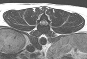 MRI image of T2 weighted transverse lumbar spine showing the spinal cord contusion of an acute non-compressive IVVD at L1-L2, note the presence of the epidural fat, hyperintense spinal cord parenchyma, and isointense material of the left side.