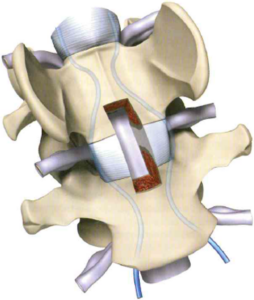 Ventral view of a ventral slot at C6–C7
