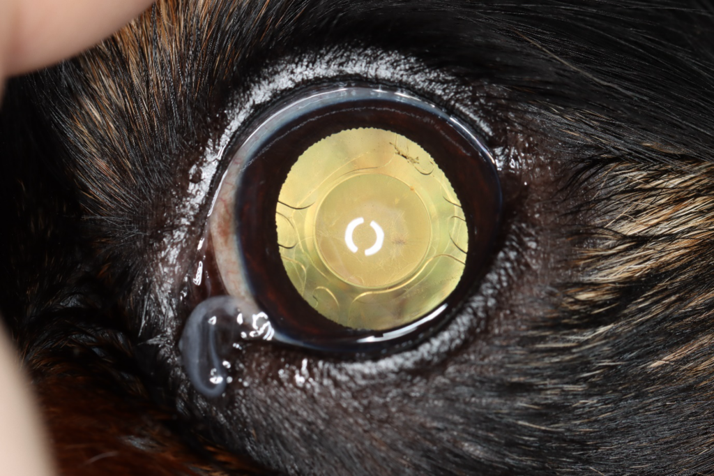 This photograph shows an eye with an artificial lens placed, after cataract surgery