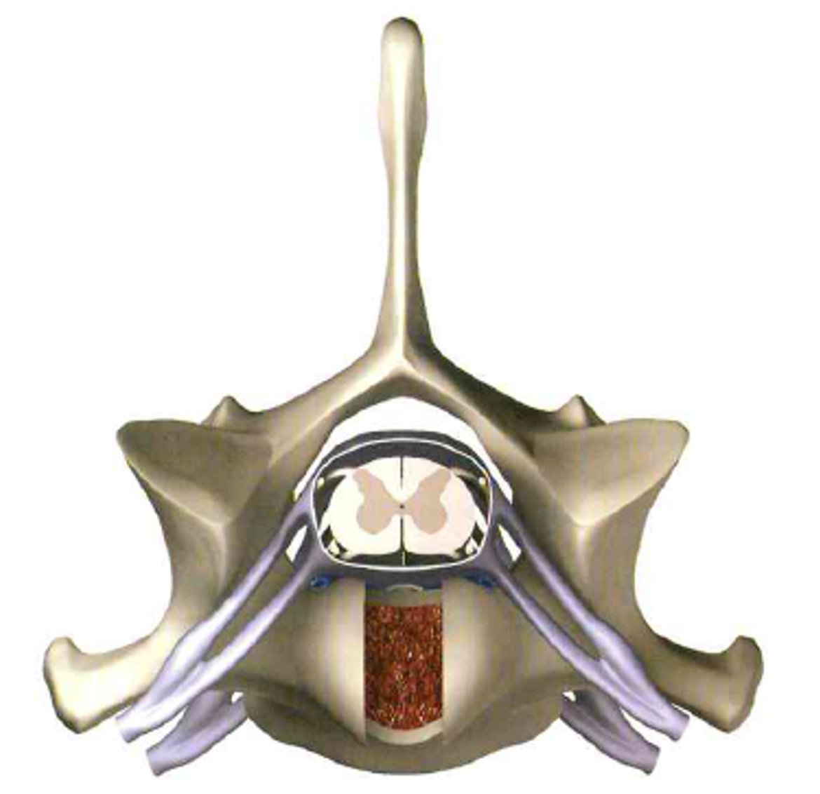 Transverse view of a ventral slot at C6–C7